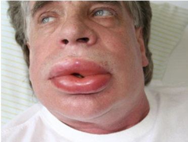 <ul><li><p>complement deficiencies can also arise from deficiencies in proteins that regulate complement pathways</p></li><li><p>patients with HAE lack a regulator of C1</p></li><li><p>symptoms of HAE include swelling of the face, lips, larynx, or GI tract</p><ul><li><p>the swelling of the larynx or GI tract are of particular concern as this can lead to suffocation or acute abdominal pain</p></li></ul></li></ul><p></p>