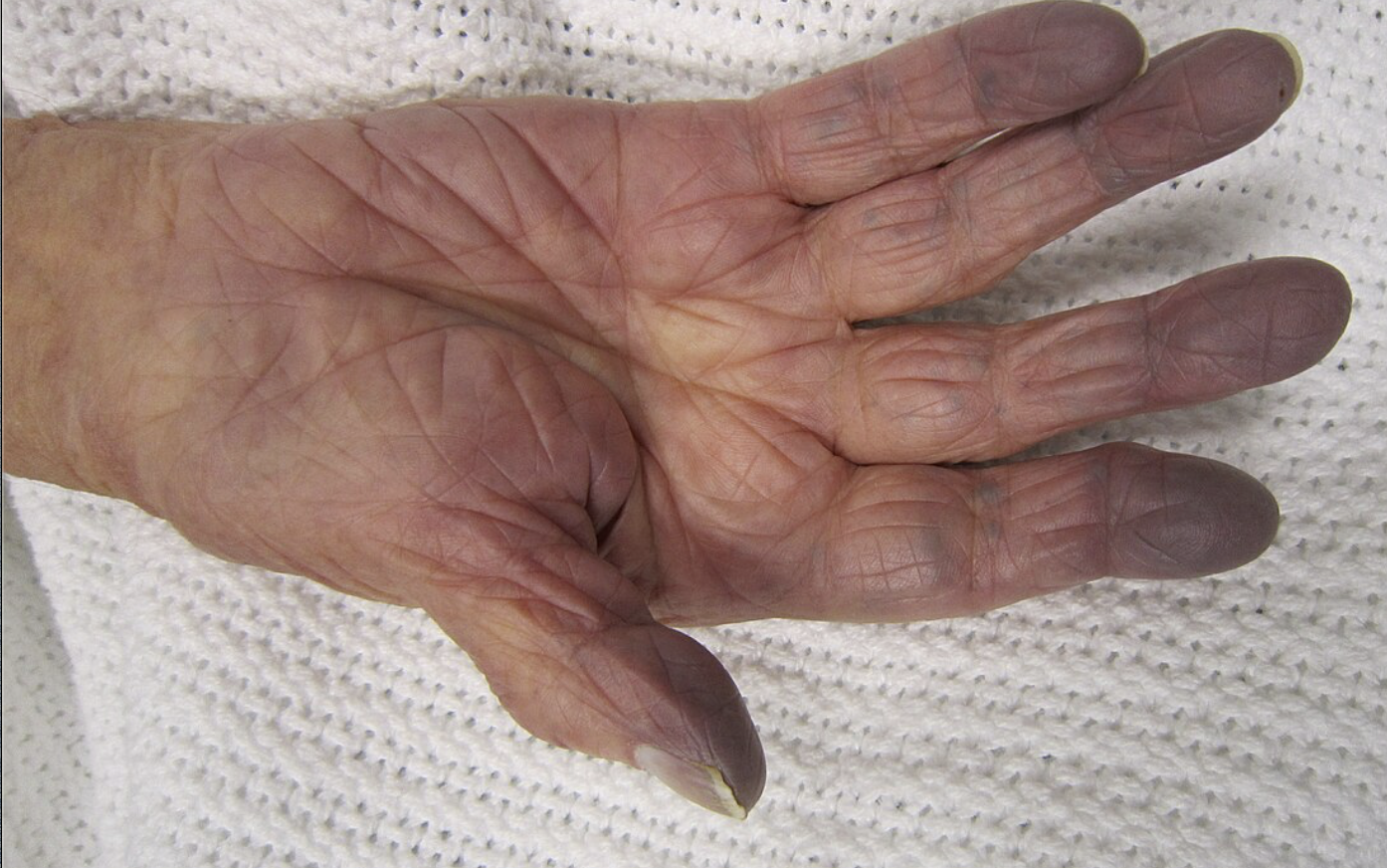 <p>low oxygenation of hemoglobin</p>