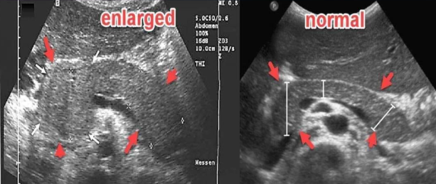<p>The pathology demonstrated on the left image is most likely:</p>