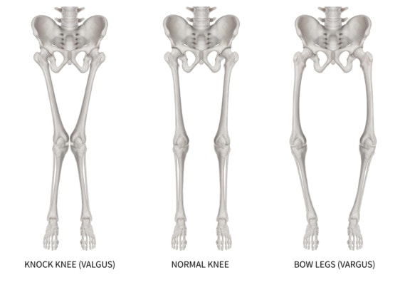 <p>Lateral collateral.</p><p></p><p>LR = Lahi Ra = Lateral collateral : checks on vaRus stresses</p><p>MG = MiGa = Medial collateral : checks on valGus stresses</p>