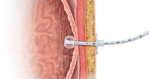 <p>MND: Late stage dysphagia management</p>
