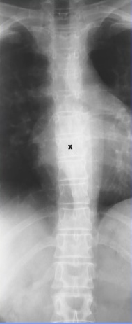 <p>What is this x-ray demonstrating?</p>