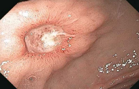 <p><strong>PUD: Diagnosis, pt. 2 </strong></p><p>-Barium Swallow</p><ul><li><p>Can identify PUD but less __________</p></li><li><p>If _______ ulcer discovered and no alarm symptoms, don’t have to have endoscopy but gastric ulcers do</p></li></ul><p>-Other tests</p><ul><li><p>Test for _.______ </p></li><li><p>Ask about _______ use</p></li><li><p>If those are both negative, then consider other causes like __________</p></li></ul><p></p>