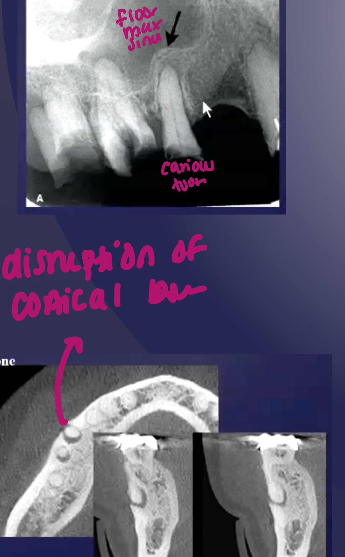 <p>what are some effects of periapical inflammatory disease on surrounding structures?</p>