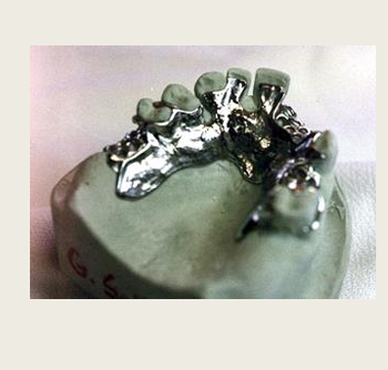 <p>Gold alloys</p><p>chrome-based developed</p><p>cobalt-chrome alloys</p><p>nickel chrome, type IV gold, titanium-based alloys</p>