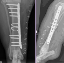 <ul><li><p><span style="background-color: transparent;"><strong><span>What:</span></strong><span> Stainless steel 18–22 gauge</span></span></p></li><li><p><span style="background-color: transparent;"><strong><span>Why: </span></strong><u><span>a</span></u><strong><u><span>djunctive, long oblique fracture</span></u></strong><span> (>2× diameter)</span></span></p><ul><li><p><span style="background-color: transparent;"><span>never sole fixation</span></span></p></li></ul></li><li><p><span style="background-color: transparent;"><strong><span>How:</span></strong><span> </span><strong><u><span>Fully encircles bone</span></u></strong></span></p><ul><li><p><span style="background-color: transparent;"><span>Anatomical reduction</span></span></p></li><li><p><span style="background-color: transparent;"><span>Use </span></span><span style="background-color: transparent; color: red;"><span>≥ 2 wires</span></span><span style="background-color: transparent;"><span> </span><strong><u><span>perpendicular</span></u></strong><u><span> to fracture line</span></u></span></p><ul><li><p><span style="background-color: transparent;"><span>Closest wire 3-5 mm from fracture</span></span></p></li><li><p><span style="background-color: transparent;"><span>Wires ~1 cm apart (closer is better)</span></span></p></li></ul></li></ul></li></ul><p></p>