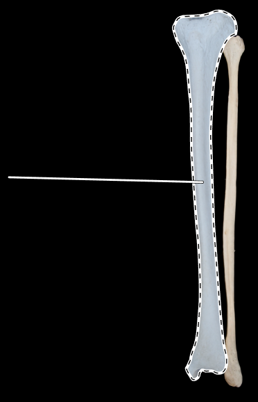 <p>Name this bone.</p><p>(Posterior view).</p>