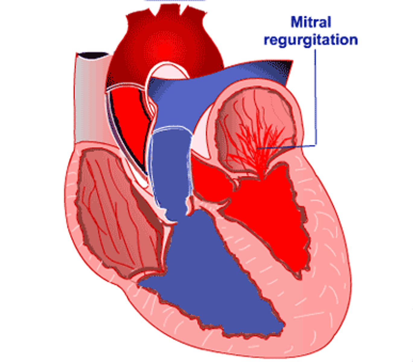 <p>Acute: causes pulmonary edema -> cardiogenic shock</p><p>· S/S: thready peripheral pulses, cool extremities</p><p>Chronic: causes hypertrophy -> decreased CO</p><p>· S/S: weakness, palpitations, progressive dyspnea, peripheral edema, S3</p>
