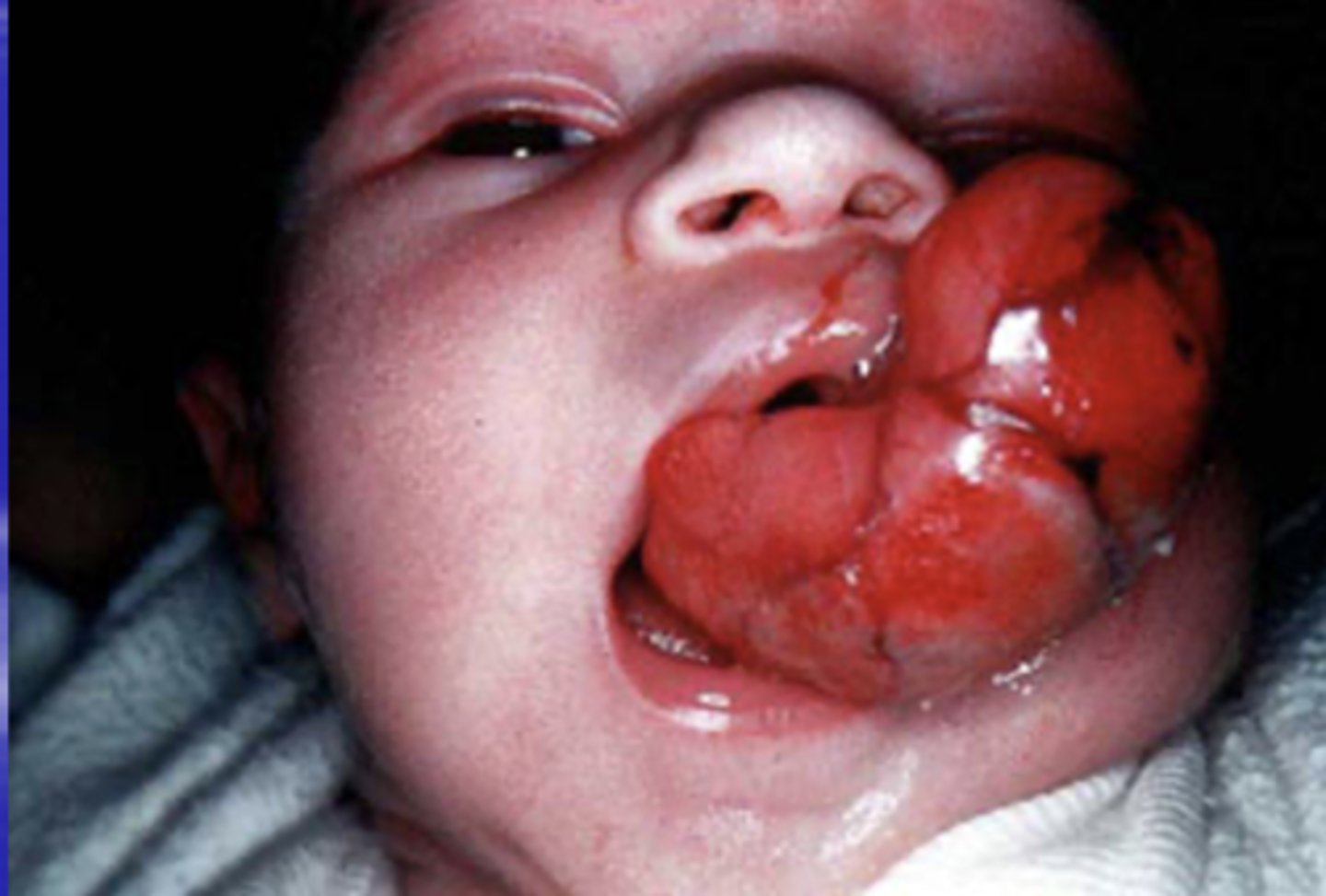 <p>proliferation of granular cells that appears as a soft, round, exophytic mass attached to the alveolar mucosa </p>