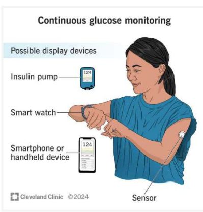 <ul><li><p>Sensor</p></li><li><p>Transmitter</p></li><li><p>Smartphone app, receiver</p></li><li><p>Insulin pump</p></li></ul><p></p>