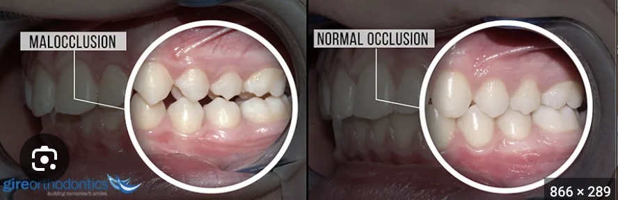 <p><span>a dental condition where the teeth are misaligned or do not meet properly</span></p>