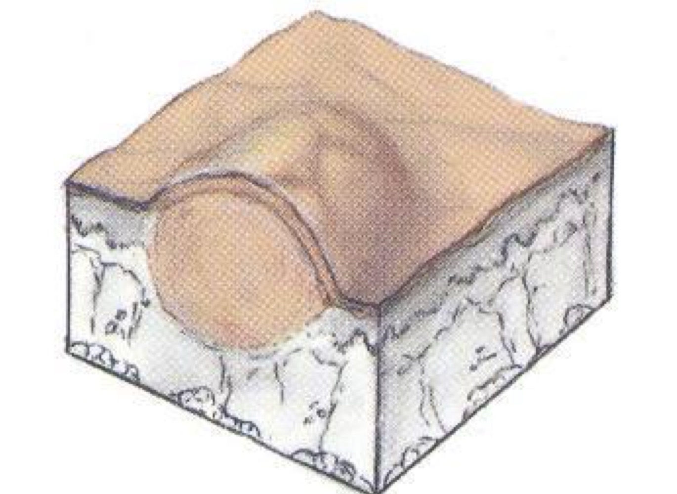 <p>what type of skin lesion is this? </p>