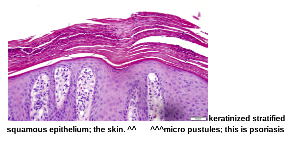 <p></p><ul><li><p>associated with <strong>stratified squamous epithelium</strong></p></li><li><p>a common chronic inflammatory skin disease characterized by pink to salmon colored plaques with silver scales and sharp margins</p></li><li><p>an autoimmune chronic inflammatory condition of the skin characterized by&nbsp; the formation of fluid filled blisters</p></li><li><p>microabcesses</p></li></ul><p></p>