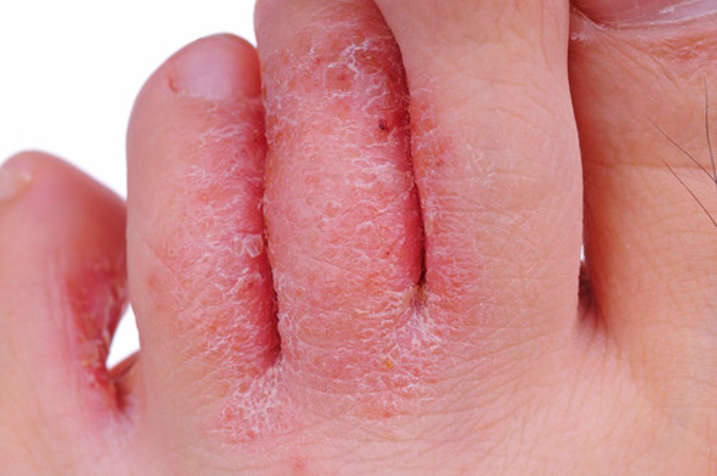 <p>a fungal skin infection that usually begins between the toes. It commonly occurs in people whose feet have become very sweaty while confined within tight-fitting shoes</p>