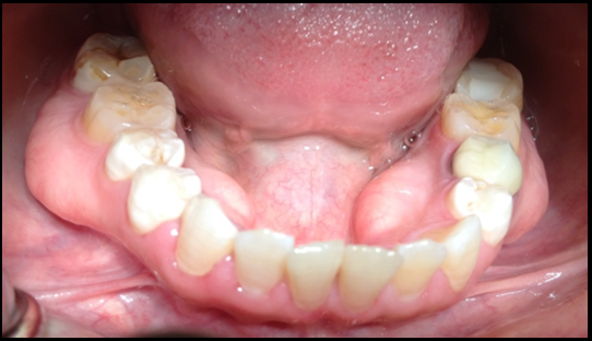 <ul><li><p>Bony projections in mandible or maxilla</p></li><li><p>Can affect dentures but are not symptomatic</p></li></ul><p></p>