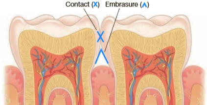 <p>Triangular space in the gingival direction when two adjacent teeth are in contact</p>