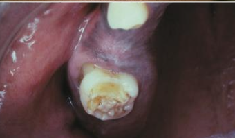 <p>hutchinson’s incisors and mulberry molars</p>