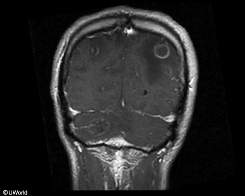 <p>hiv+, sometimes missed prophy, 2 weeks of headaches and confusion. friends say he’s aggressive and suspicious, which is not normal for him. </p>