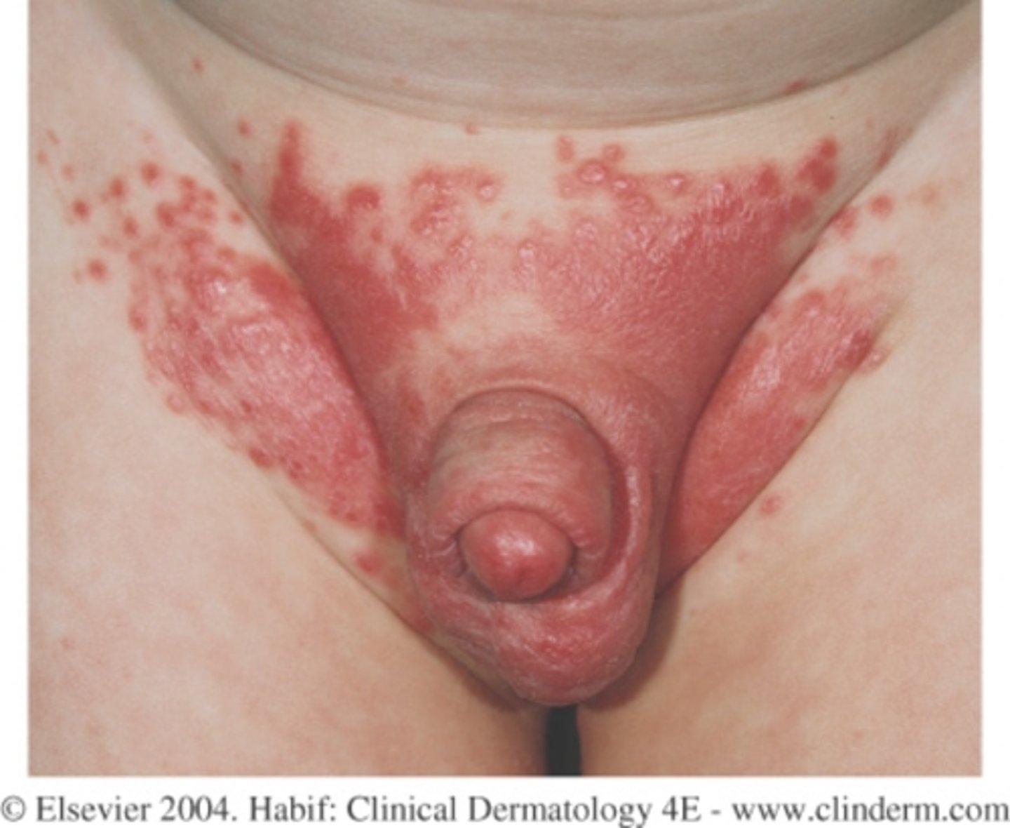<p>Candida involves the skin folds and has "satellite lesions"; Irritant spares the folds</p>