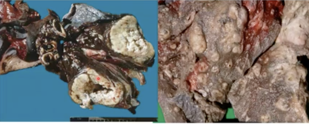 Non-small cell carcinoma