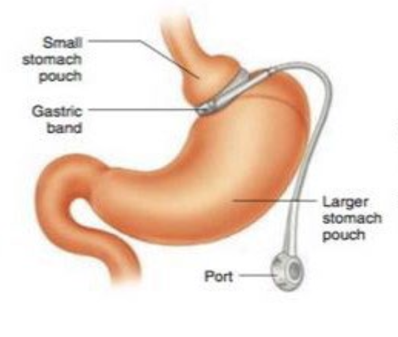 <p>Adjustable gastric band procedure</p>
