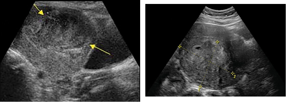 <p> Rare, solid tumor arising from myometrium or endometrium</p><p class="p1"> Commonly in fundus of uterus</p><p class="p1"> Most common in women 40 to 60 years of age</p><p class="p1"> Rapid growth</p><p class="p1"> Sarcoma botryoides: very rare condition in children characterized by</p><p class="p1">grapelike clusters of tumor mass</p><p class="p1">Sonographic findings</p><p class="p1"> Leiomyosarcoma may resemble myomas or endometrial carcinoma with</p><p class="p1">features of solid or mixed-solid and cystic texture.</p><p class="p1"> Clinically, rapid enlargement of solid uterine mass in perimenopausal or</p><p class="p1">postmenopausal patient raises concern about development of</p><p class="p1">malignancy.</p>