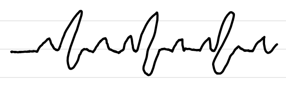 <ul><li><p>rate: <span style="color: red;">100-150 bpm</span></p></li><li><p>rhythm: regular</p></li><li><p>P waves: normal</p></li><li><p>PR interval: 0.12-0.20 sec</p></li><li><p>QRS complexes: <0.10 sec</p></li><li><p>ST segments: normal</p></li></ul><p></p>