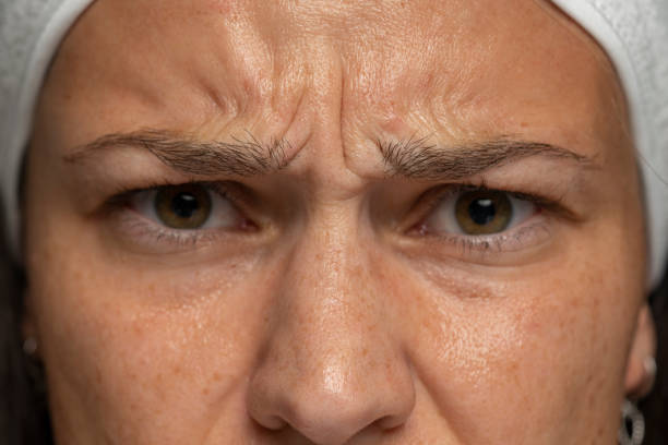 <ul><li><p>Muscle:<span style="color: rgb(195, 202, 255);"><strong><u> corrugator supercili</u></strong></span></p></li></ul><p></p>