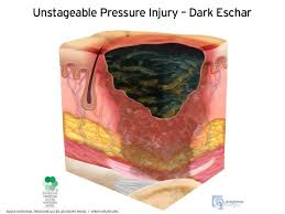 Depth unknown due to slough or eschar covering, requires debridement.