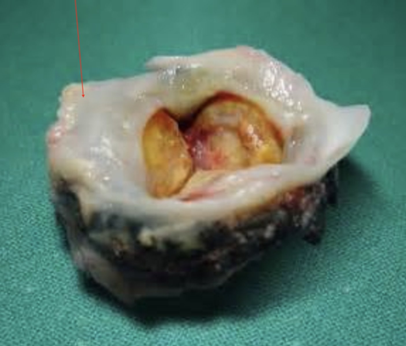 <p>Overgrowth of normal tissue into valve</p>