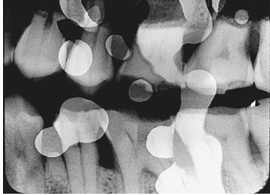 <p>What is the problem with this FIXER SPOTS X-ray? </p>