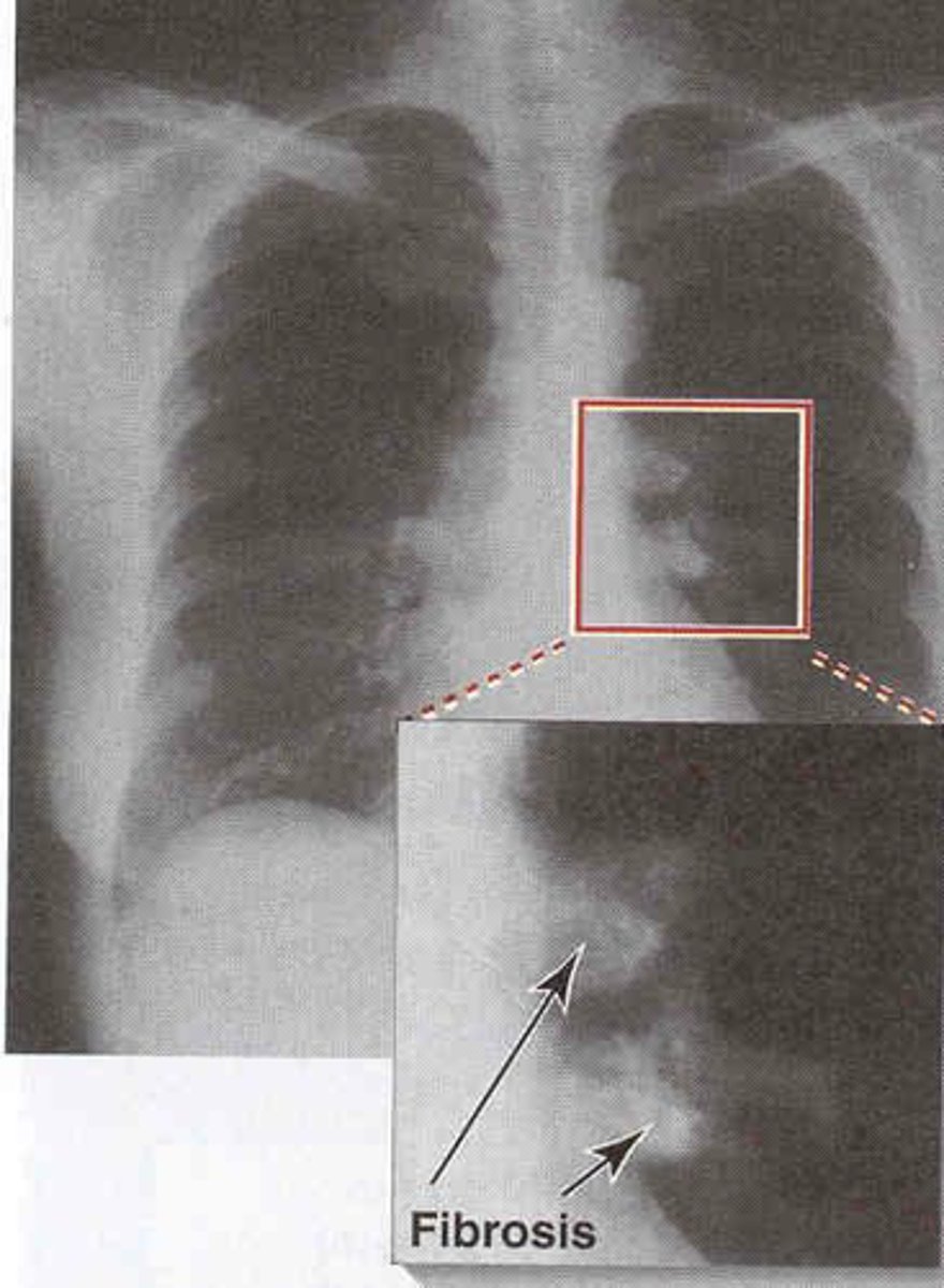 <p>Systemic spread of Mycobacterium tuberculosis via blood, appearing as tiny spots on X-ray.</p>
