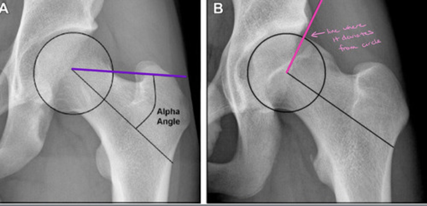 <p>Measures the extent to which the femoral head deviates from spherical</p><p>Normal = <50 degrees</p><p>FAI = >50 degrees</p>