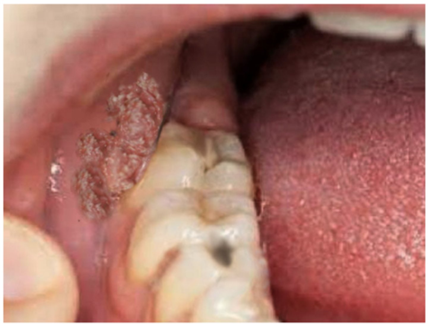 <p>Commonly HPV-6 and -11</p><p>Usually benign</p><p>Treated with excision, cryotherapy, trichloroacetic acid, Imiquimod</p><p>Usually sexually transmitted</p>