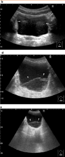 <ul><li><p><span style="background-color: transparent;">Occurs when echoes from the preceding pulse arrive at a time when another pulse has been emitted</span></p></li><li><p><span style="background-color: transparent;">Causes:</span></p><ul><li><p><span style="background-color: transparent;">Depth is relatively shallow and a low attenuating structure lies beyond the field of view (FOV)</span></p></li><li><p><span style="background-color: transparent;">Multiple focal zones - because image is stitched together</span></p></li></ul></li><li><p><span style="background-color: transparent;">Reduce:</span></p><ul><li><p><span style="background-color: transparent;">For structure beyond FOV - decrease output power or gain</span></p></li><li><p><span style="background-color: transparent;">Switch to one focal zone</span></p></li></ul></li></ul><p></p>