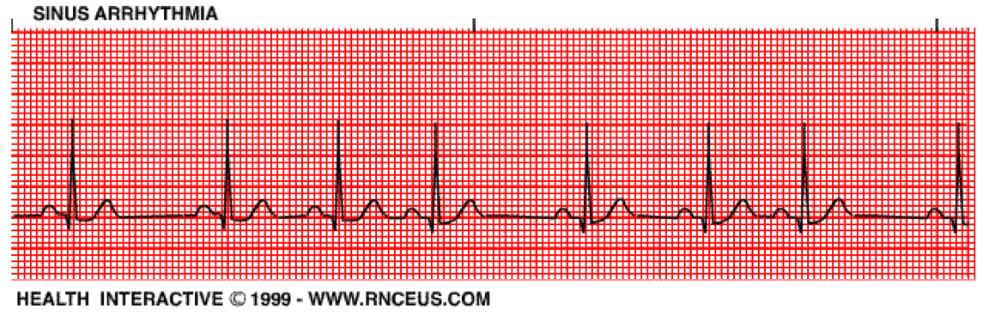 <p>Sinus arrthymia</p>