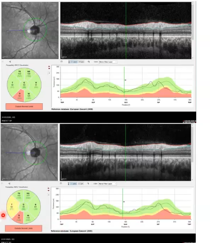 <p>scan capture issues: same eye, 30 secs apart </p>