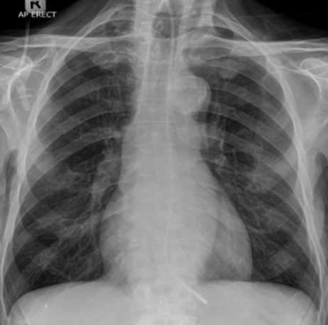 <p>describe the incorrect NG tube placement</p>