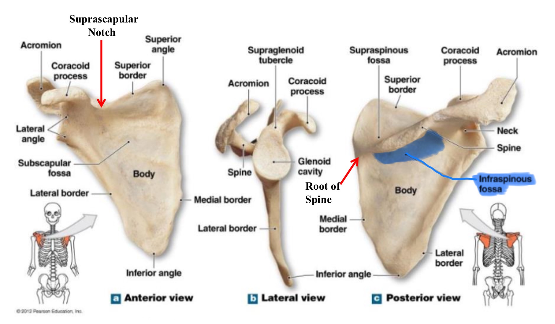 <p>infraspinous fossa of scapula</p>