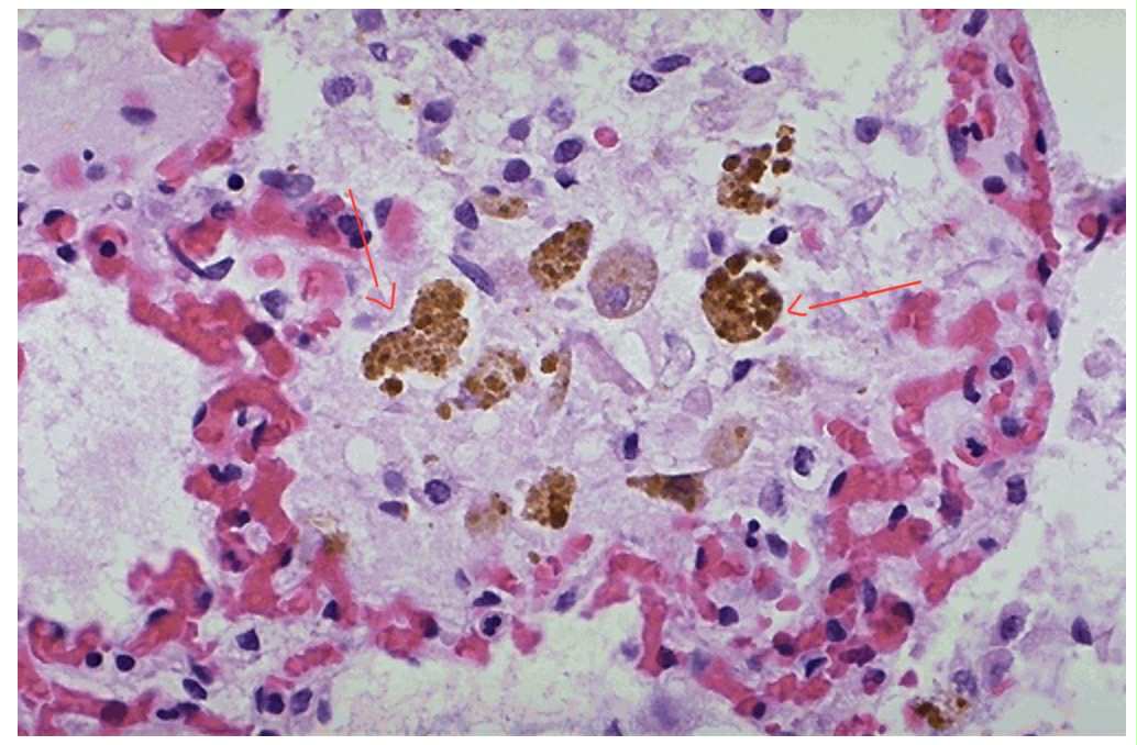 <p>Histological section of an alveolus with macrophages. Identify what the brown coarsely granular material is. What results from this accumulation?</p>