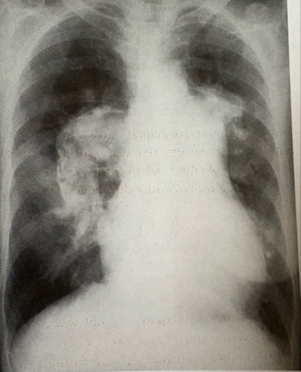 <p>what pathology is present?</p>