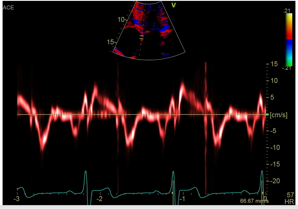 <p>Obtain a septal TDI (w/proper sample volume gate) gate 5-10mm</p>