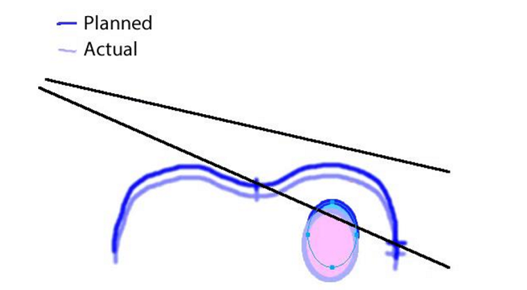 <p>the isocenter is too anterior (so the patient is too posterior)</p><ul><li><p>the lung is actually receiving less dose than it should be (because there is not enough CW coverage)</p></li></ul><p></p>