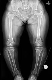 <p>most common form of dwarfism. results from diminished proliferation of cartilage in the growth plate (decreased enchondral bone formation)</p><p>It is an autosomal dominant condition.</p><p></p>