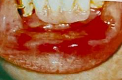 <ul><li><p>Identify the disease</p></li><li><p>Etiology</p></li><li><p>Clinical Features</p></li><li><p>Oral manifestation</p></li><li><p>Treatment</p></li></ul><p></p>