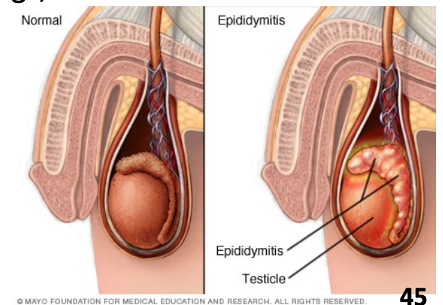 <ul><li><p><strong>Inflammation of the epididymis</strong></p><ul><li><p class="p2">Most common cause of acute scrotal pain in adults</p></li></ul></li></ul><p></p>