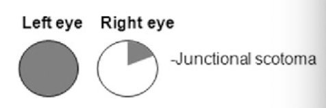 <p>junctional scotoma</p>