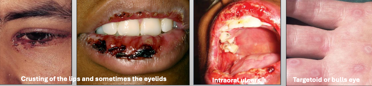 <ul><li><p>You get prodromal signs a week before</p></li><li><p>Crusting of the lips and sometimes the eyelids</p></li><li><p>Intraoral ulcers</p></li><li><p>Targetoid or bulls eye</p></li></ul><p></p>