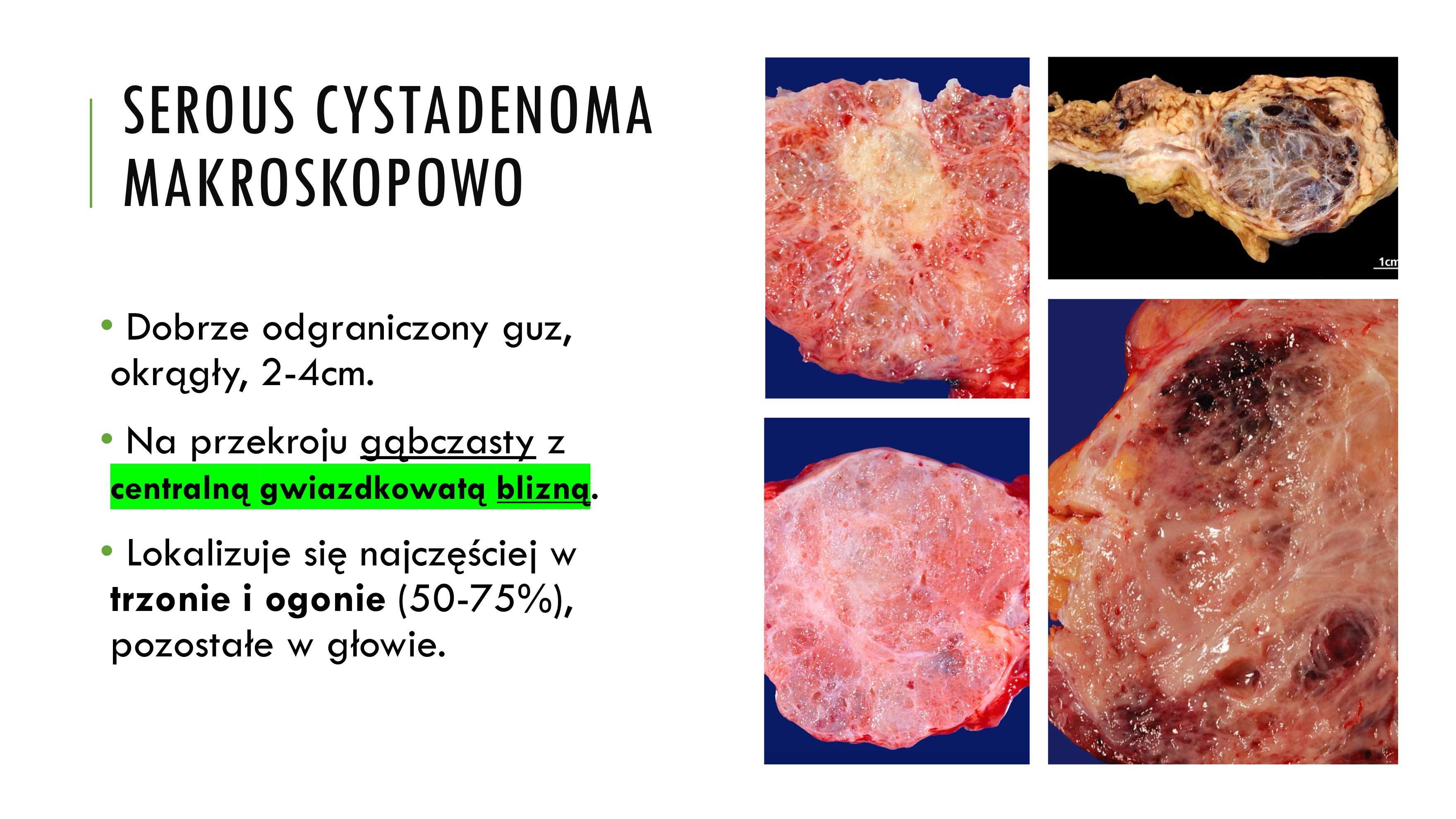 <p>v Łagodny nowotwór torbielowaty.</p><p>v 25% nowotworów torbielowatych trzustki</p><p>v 2x częściej u kobiet, 7 dekada</p><p>v Objawy nietypowe - ból brzucha lub badalny guz.</p><p>v Somatyczna mutacja genu supresyjnego VHL.</p><p>v Prognoza doskonała, prawie zawsze łagodne, wycięcie jest</p><p>wystarczającym leczeniem</p><p>• Dobrze odgraniczony guz,</p><p>okrągły, 2-4cm.</p><p>• Na przekroju gąbczasty z</p><p>centralną gwiazdkowatą blizną.</p><p>• Lokalizuje się najczęściej w</p><p>trzonie i ogonie (50-75%),</p><p>pozostałe w głowie</p><p>Liczne drobne (1-2mm)</p><p>torbielki, wyścielone</p><p>sześciennym nabłonkiem o</p><p>jasnej cytoplazmie (glikogen).</p><p>W łącznotkankowych</p><p>przegrodach przewlekłe</p><p>nacieki zapalne, makrofagi z</p><p>hemosyderyną i zwapnienia</p>