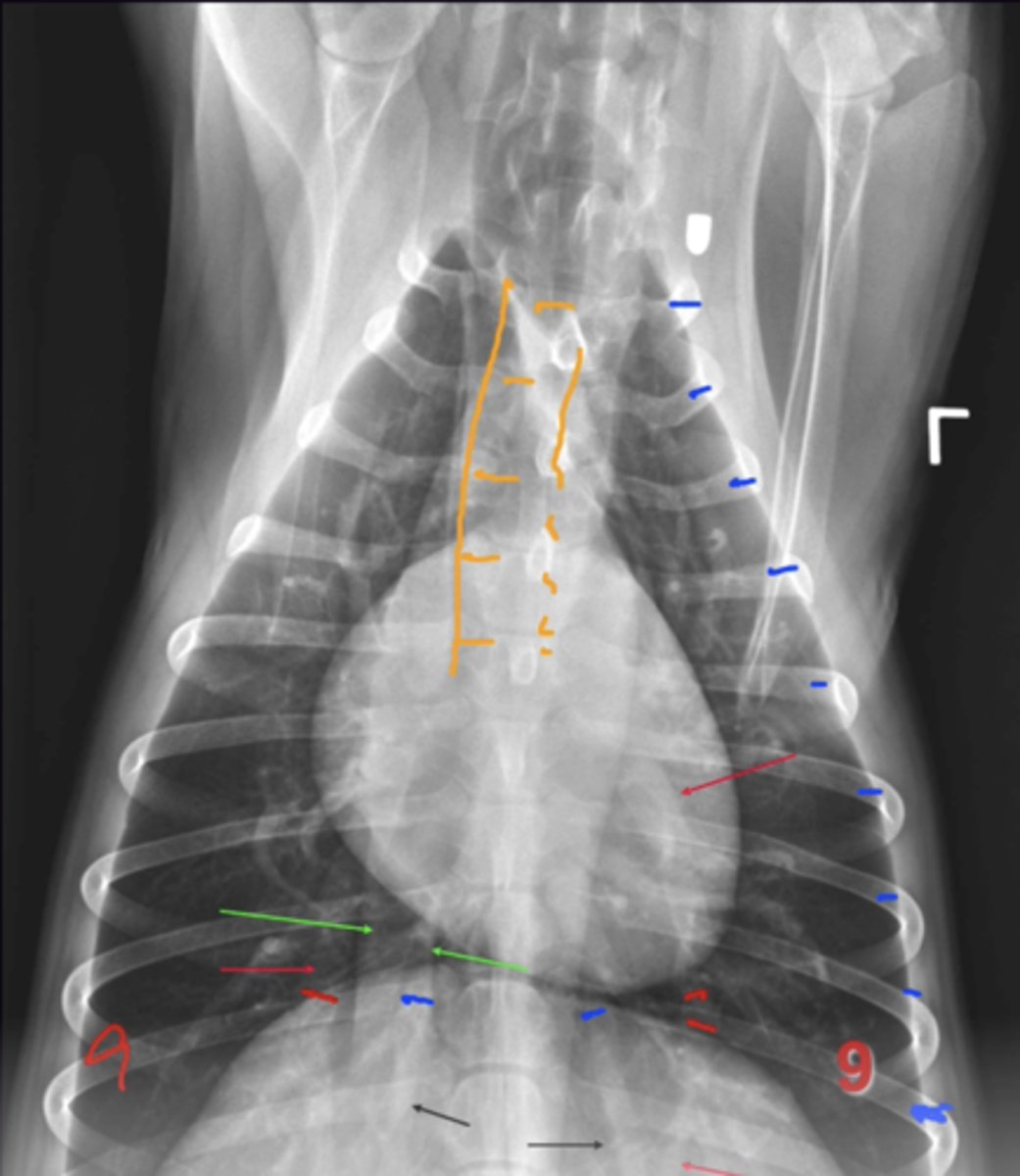 <p>1. Caudal Lobar Vessels</p><p>2. Are they the same Width</p><p>3. Taken on the 9th rib,. Look at the width of the PA + PV where the 9th rib crosses them. Width of the Vessels should be less than width of the rib (Normal PA + PV is approx. 3/4 the width of the rib)</p>